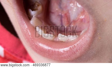 Crooked Teeth In A Child's Mouth. The Permanent Tooth Grows Next To The Milk Tooth, Close-up