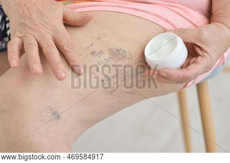 Elderly Woman Applies Healing Ointment On Legs With Thrombosis And Varicose Veins