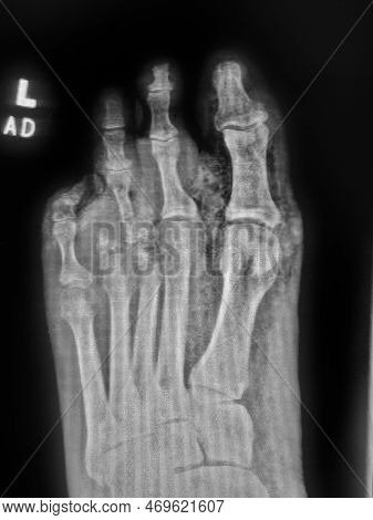 Gangrenous Left Foot In Diabetic Patient - Soft Tissue Gas On Xray