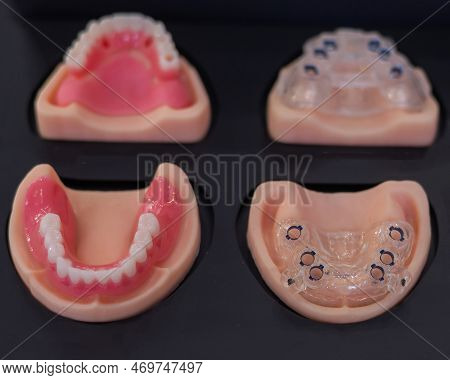 Samples Of Special Templates For Implantation, Jaw Prostheses.