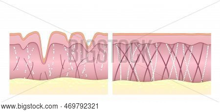 Collagen And Elastin Fibers In Young And Wrinkled Skin Comparison. The Medical Illustrations Show Re