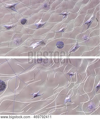 Collagen Destruction Process. Comparison Skin Extracellular Matrix Structure In Young Healthy Skin A