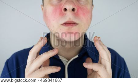 Rosacea Face. The Man Suffers From Redness On Her Cheeks. Couperose Of The Skin. Redness And Capilla
