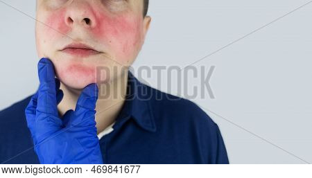 Rosacea Face. The Man Suffers From Redness On Her Cheeks. Couperose Of The Skin. Redness And Capilla
