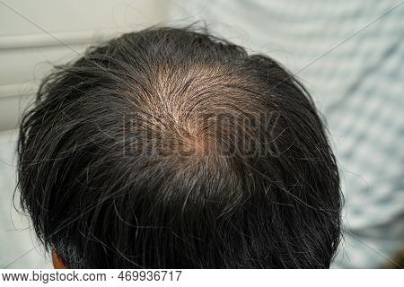 Bald In The Middle Head And Begin No Loss Hair Glabrous Of Mature Asian Business Smart Active Office