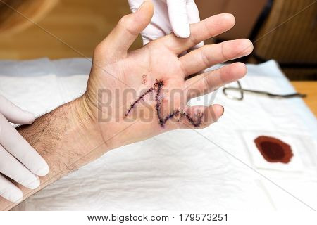 Aftertreatment of an operation suture on one hand