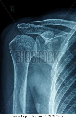 X-ray film of primary frozen shoulder or adhesive capsulitis of Asian female patient