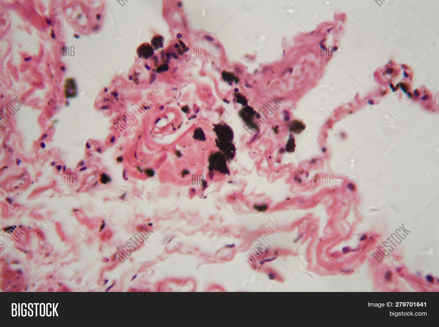 Human Lung Tissue Dust Image & Photo (Free Trial) Bigstock