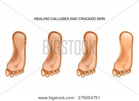 Vector Illustration Of The Healing Calluses And Cracked Heels
