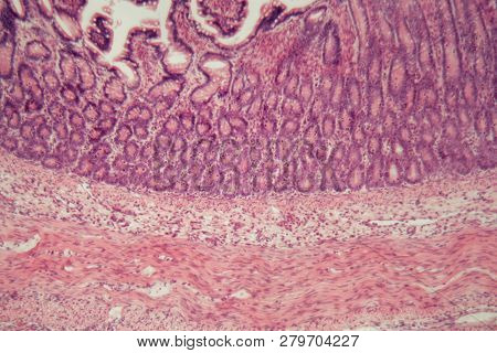 Microscope Photo Of A Large Intestine Section With Inflammation (colitis).