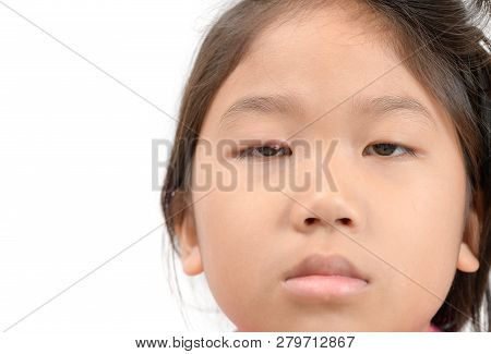 Close Up Of Asian Little Girl One Eye Infection Isolated