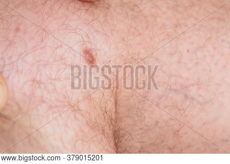 Health And Wellness - Photo Of A Dermato Fibroma On The Leg