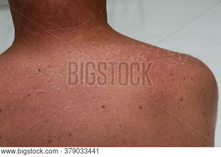 Healing Of The Sunburn And Redness On The Back - Close-up