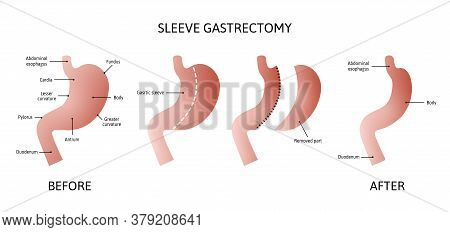 Vertical Sleeve Gastrectomy. Human Stomach Anatomy Isolated On White Background. Decrease In Stomach