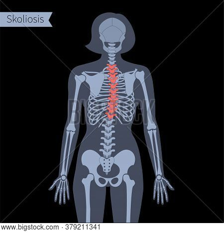 Thoracic Scoliosis In Female Body. Xray Flat Vector Illustration. Spine, Backbone, Joint And Skeleto