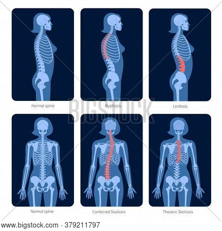 Normal Spine And Types Of Spine Defects. Scoliosis In Woman Body. Xray Flat Vector Illustration. Bac