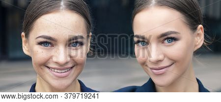Comparison Portrait Of Beautiful Happy Woman With Problematic Skin. Two Photos Of Before And After S