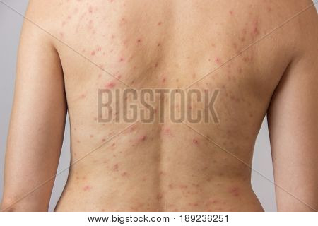 Young girl with acne with red spots on the back