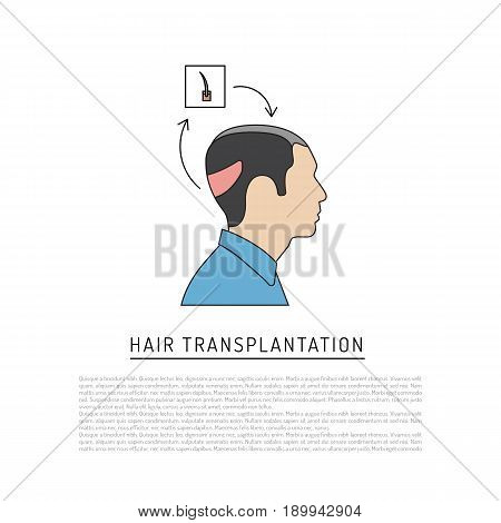 Infographics on the topic of transplantation of hair from the occipital region of the head at the place of baldness. The scheme drawn in vector in flat style