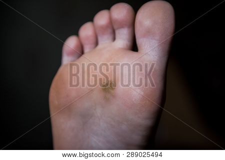 Corn On Man Foot Close Up On