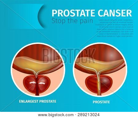 Prostate Cancer. Stop The Pain Medical Banner. Normal And Enlargest Prostate. Oncological Or Urologi