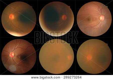 Collection Of Retinal Image  Of The Patient Taken With Retinal Photography Machine.