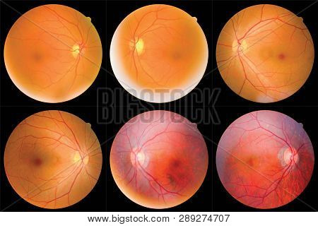Collection Of Retinal Image  Of The Patient Taken With Retinal Photography Machine.