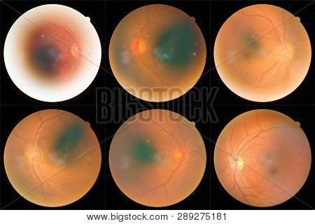 Collection Of Retinal Image  Of The Patient Taken With Retinal Photography Machine.