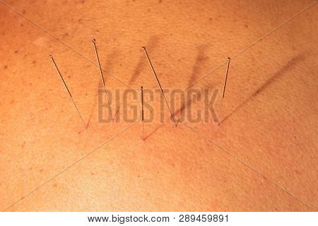 Several Acupuncture Needles To Make Treatment. Traditional Chinese Medicine Made With The Insertion 