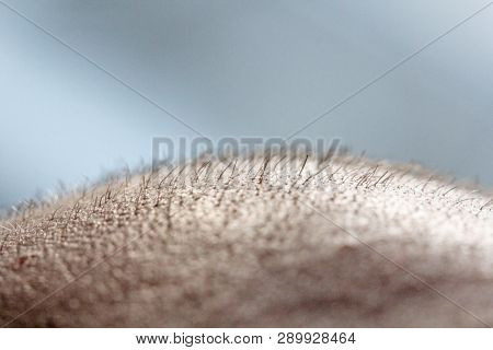 Short Hair On A Head Close Up. Scalp Man's Head. Baldness. Bald Man. Problems With Hair Growth On Th