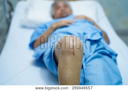 Asian Senior Or Elderly Old Lady Woman Patient Show Her Scars Surgical Total Knee Joint Replacement 