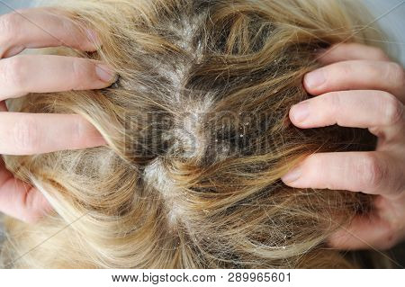 Dandruff Seborrhea Problem Of Scalp And Hair Treatment Of Peeling From Allergies Or Lichen