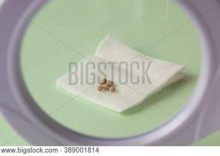 The Gallstones After A Laparoscopy Under A Magnifying Glass