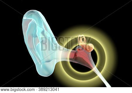Otitis Media, Inflammatory Disease Of The Middle Ear, 3d Illustration