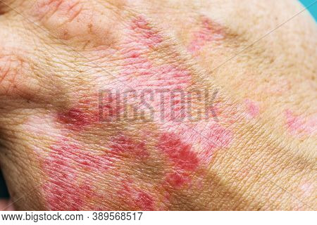 Burns Of Hand, Wounds. Hand With Sunburn. Type Of Burn.