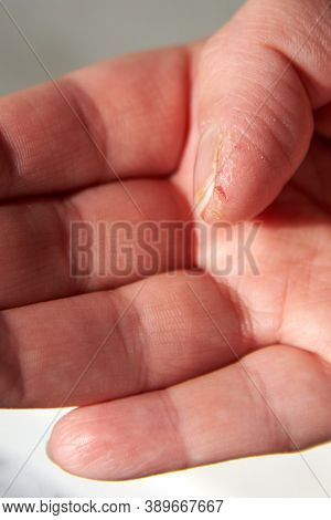 Cracked And Dry Skin On A Woman's Thumb, Close-up, The Theme Of Allergies And Diseases Of Nails And 