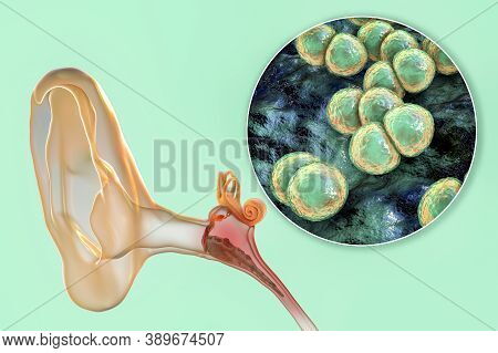 Otitis Media Caused By Bacteria Streptococcus Pneumoniae, An Inflammatory Disease Of The Middle Ear,