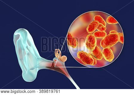 Otitis Media Caused By Bacteria Haemophilus Influenzae, Inflammatory Disease Of The Middle Ear, 3d I