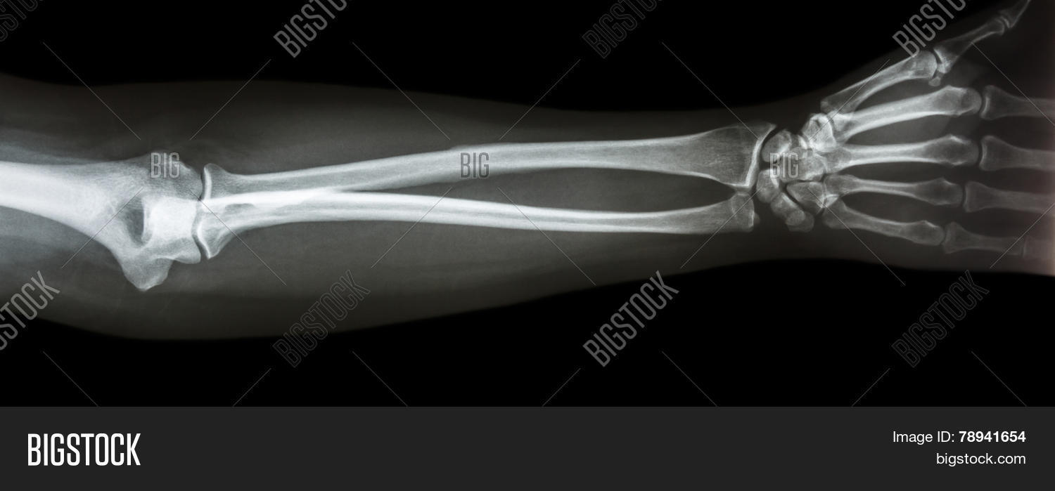 Film Xray Forearm Ap( Image & Photo (Free Trial) Bigstock