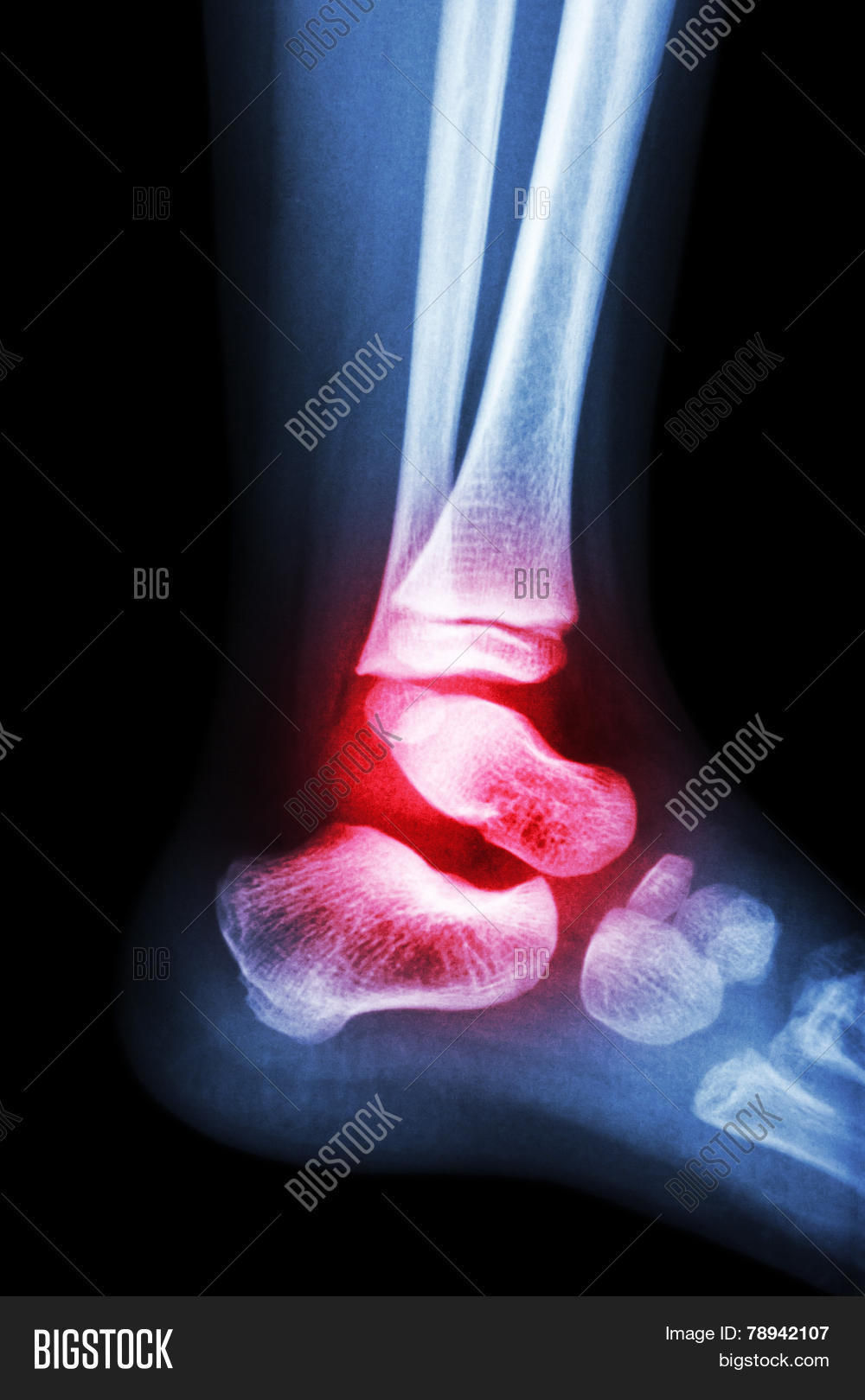 Крузартроз голеностопного сустава что это. Крузартроз голеностопного сустава что это. Крузартроз голеностопного сустава что это. Деформирующий артроз голеностопного сустава рентген. Крузартроз голеностопного сустава что это.