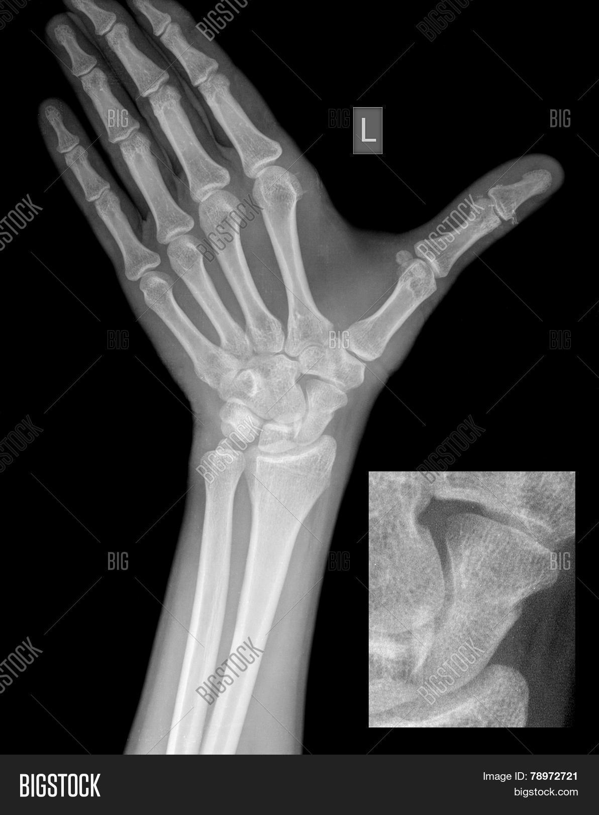 bones of the hand x ray