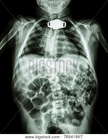 X-ray Body Of Child And Tracheostomy Tube