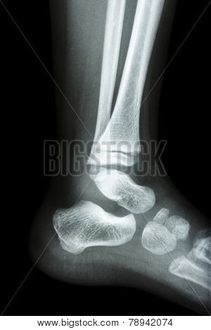 film x-ray ankle of child on black background