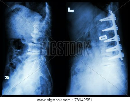 "Spondylosis" (Left image) , Patient was operated and internal fixed. (Right image) in old man