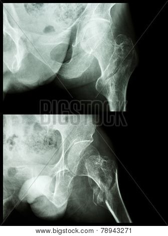 Fracture Head Of Femur(thigh Bone) (intertrochanteric Fracture)  (2 Position)