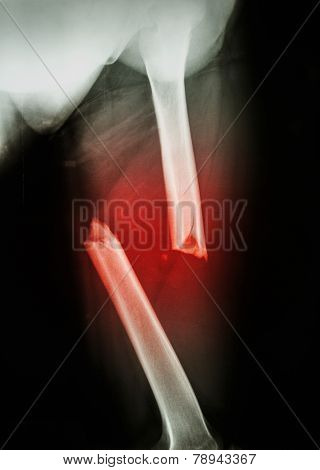 Fracture Femur