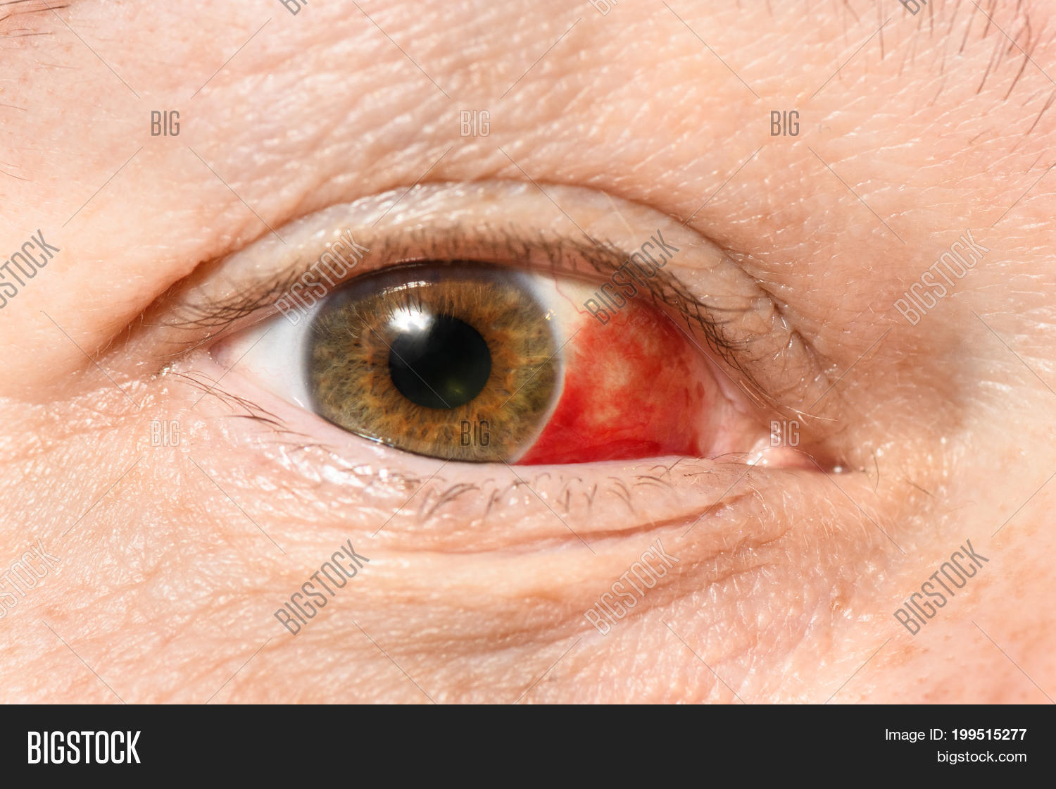 Subconjunctival image photo free trial bigstock