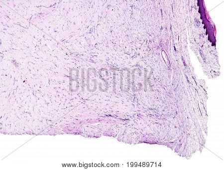 Connective tissue, hyaline degeneration of a human, highly detailed segment of panorama. Photomicrograph as seen under the microscope, 10x zoom.