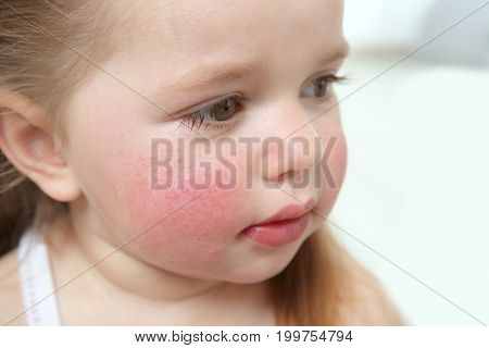 Portrait of little girl with diathesis symptoms on cheeks, closeup