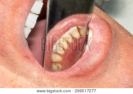 Human Teeth With Smoking Plaque And Tartar. Close-up Macro  Dental Clinic. Hygiene Concept
